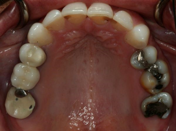 Dentures Implants Syracuse UT 84075